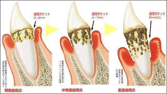 歯周病の進行